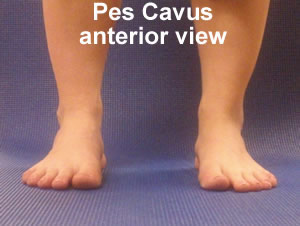 bilateral pes planus